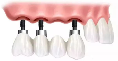 延長種植牙使用壽命的方法