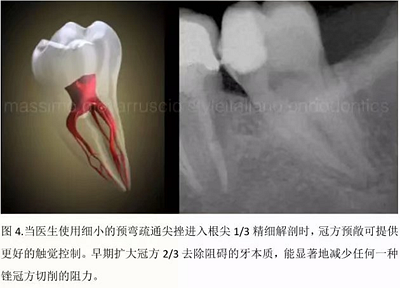 【病例分享】根管冠部預(yù)敞