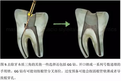 【病例分享】根管冠部預(yù)敞