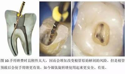 【病例分享】根管冠部預(yù)敞