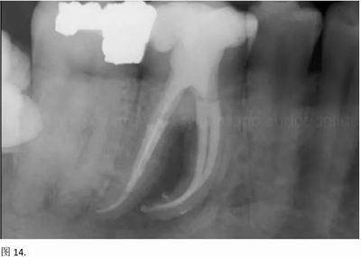 【病例分享】根管冠部預(yù)敞