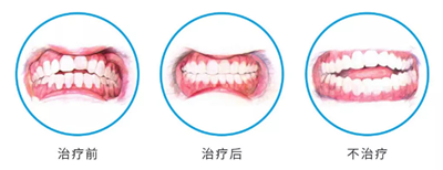 兒童早期矯治問(wèn)題