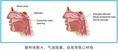 兒童早期矯治問(wèn)題