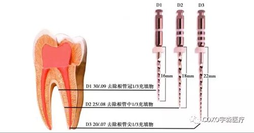 （十一期）根管充填物的清理-牙膠的去除