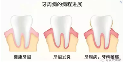 怎樣預(yù)防牙齦萎縮