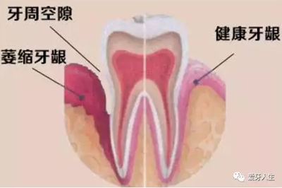 什么是牙齦萎縮？