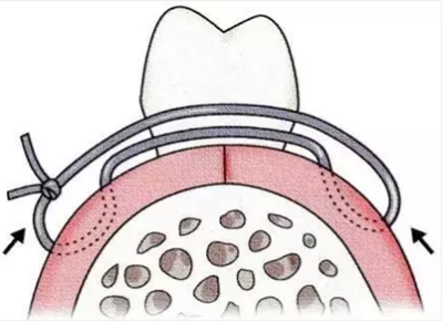 【牙周外科的基本技術(shù)技能】術(shù)后管理