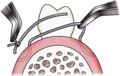 【牙周外科的基本技術(shù)技能】術(shù)后管理
