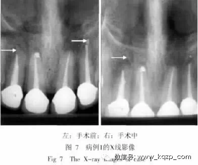 X線牙片在牙齒疑難病例診斷中的參考價值