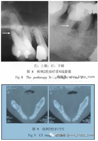 X線牙片在牙齒疑難病例診斷中的參考價值