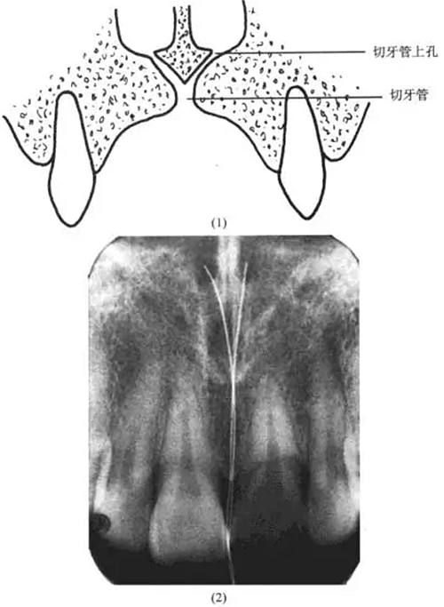切牙管上孔