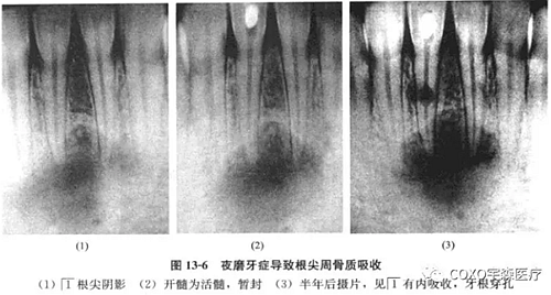 根尖周病與夜磨牙癥