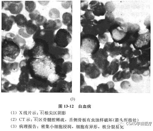 根尖周病的鑒別診斷