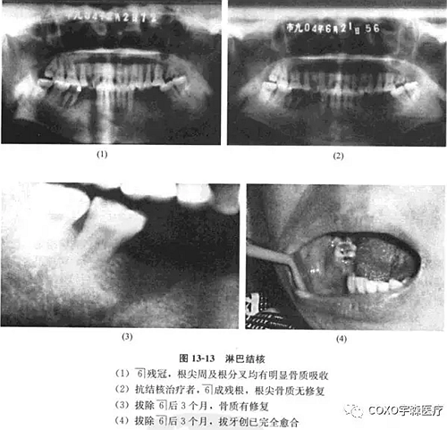 根尖周病與骨結(jié)核