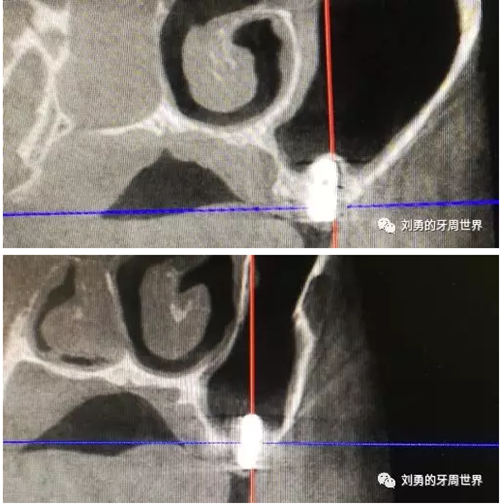 失敗上頜竇種植患者的補(bǔ)救