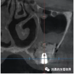 一例失敗上頜竇種植患者的補(bǔ)救