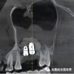 一例失敗上頜竇種植患者的補(bǔ)救