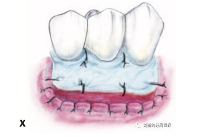 FGG游離牙齦移植在歷史上的各種改良以及發(fā)展前景