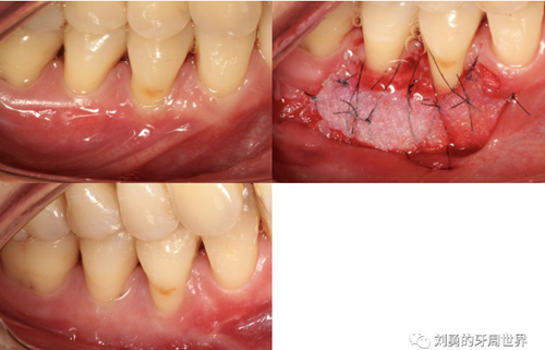 FGG游離牙齦移植在歷史上的各種改良以及發(fā)展前景
