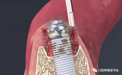 種植體周圍炎的軟硬組織重建治療（上）