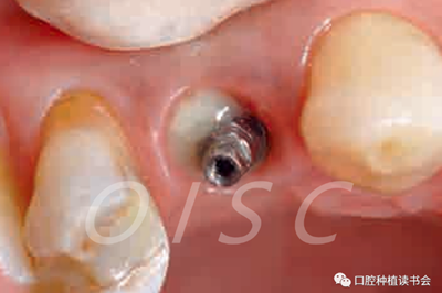 種植體周圍炎的軟硬組織重建治療（上）