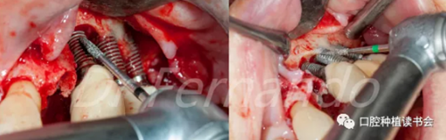 種植體周圍炎的軟硬組織重建治療(下)