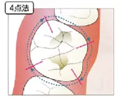 牙周袋深度測定法