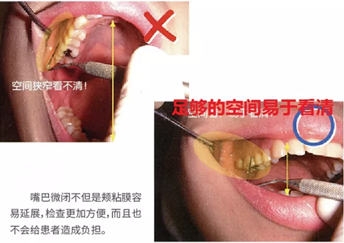 牙周袋深度測定法