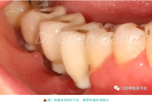 高清圖解｜游離牙齦（FGG）的獲取與移植技術(shù)