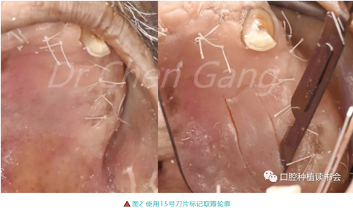 高清圖解｜游離牙齦（FGG）的獲取與移植技術(shù)