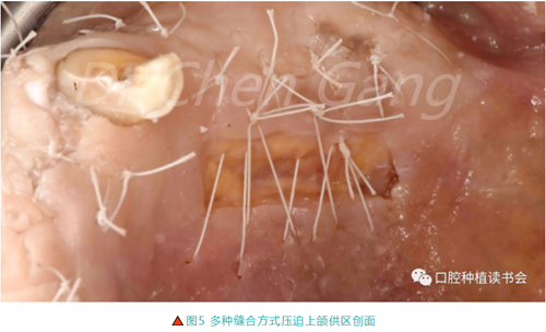 高清圖解｜游離牙齦（FGG）的獲取與移植技術(shù)