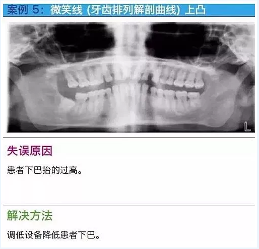 曲斷的10大經(jīng)典失誤案例及原因分析！