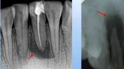 各類根尖周病的X片表現(xiàn)