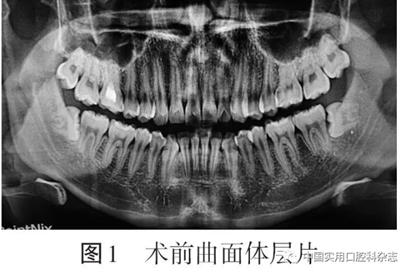 病例報(bào)告 | 下頜第三磨牙拔除術(shù)后并發(fā)雙側(cè)廣泛性皮下氣腫及縱隔氣腫1例報(bào)告