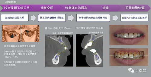 【病例分享】應用全程數(shù)字化對牙周炎患者實現(xiàn)全口即刻種植即刻修復