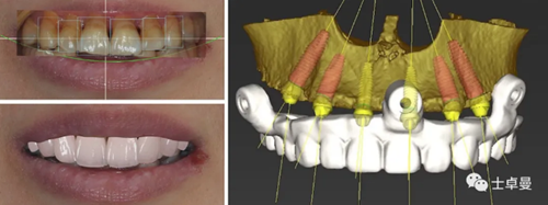 【病例分享】應用全程數(shù)字化對牙周炎患者實現(xiàn)全口即刻種植即刻修復