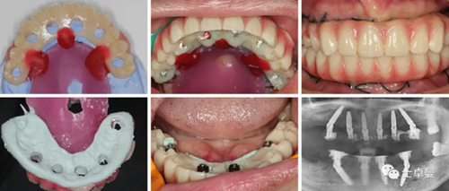 【病例分享】應用全程數(shù)字化對牙周炎患者實現(xiàn)全口即刻種植即刻修復