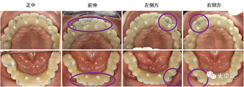 【病例分享】應用全程數(shù)字化對牙周炎患者實現(xiàn)全口即刻種植即刻修復