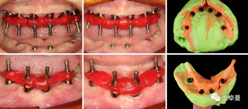【病例分享】應用全程數(shù)字化對牙周炎患者實現(xiàn)全口即刻種植即刻修復