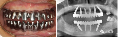 【病例分享】應用全程數(shù)字化對牙周炎患者實現(xiàn)全口即刻種植即刻修復