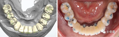 【病例分享】應用全程數(shù)字化對牙周炎患者實現(xiàn)全口即刻種植即刻修復