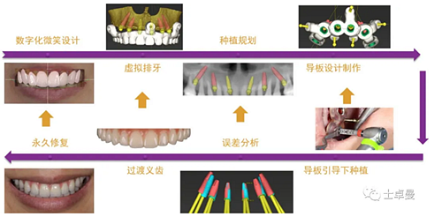 【病例分享】應用全程數(shù)字化對牙周炎患者實現(xiàn)全口即刻種植即刻修復