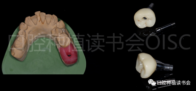 后牙區(qū)即刻種植臨床指南