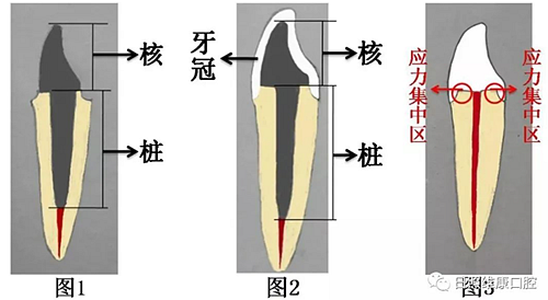 口腔科普 | 殘根殘冠怎么辦——樁核冠