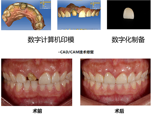 妙手牙醫(yī)丨殘根、殘冠還有保留的意義嗎？