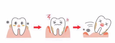 牙周病總是來(lái)勢(shì)洶洶？有辦法預(yù)防嗎？