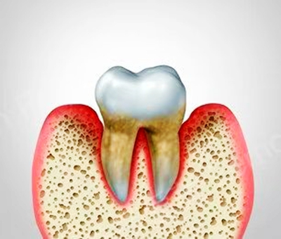 牙周病總是來(lái)勢(shì)洶洶？有辦法預(yù)防嗎？
